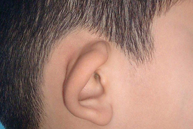 中度杯状耳耳部症状图