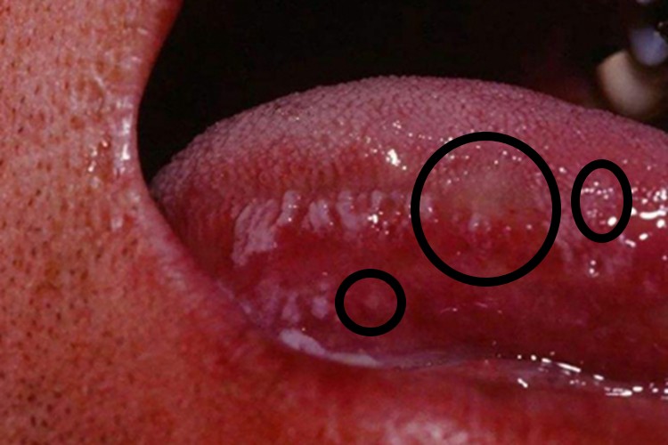 口腔寻常狼疮结节图