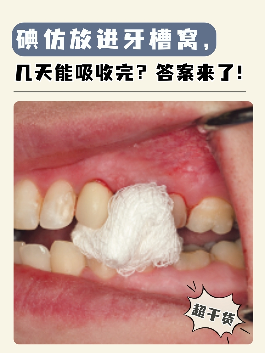 碘仿放进牙槽窝,几天能吸收完?答案来了!