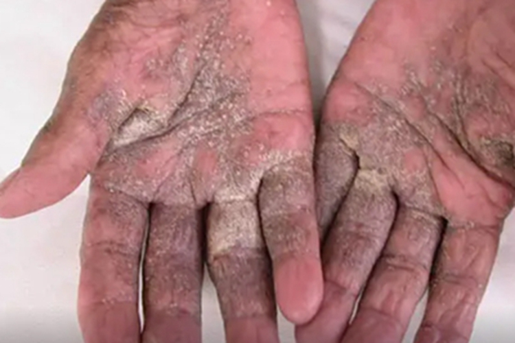 结痂性疥疮手掌脱屑图