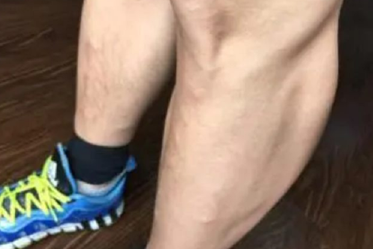 肌疝大腿肌肉外翻图