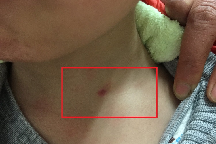 鳃裂瘘管红点图