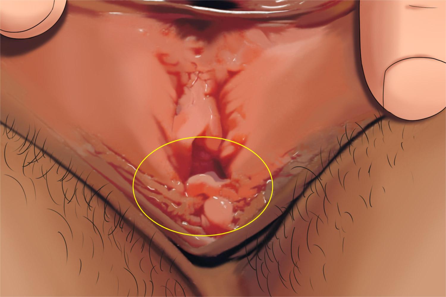 假性湿疣阴道症状手绘图 假性湿疣阴道症状手绘图