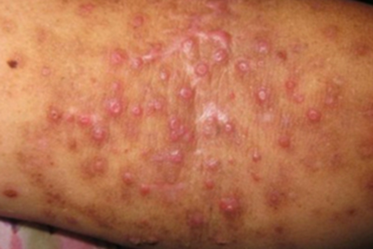 痘疮样型副银屑病脓包图
