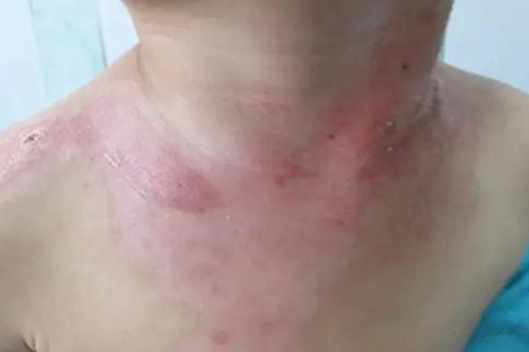 二度烫伤脖子发红有扁平水疱图