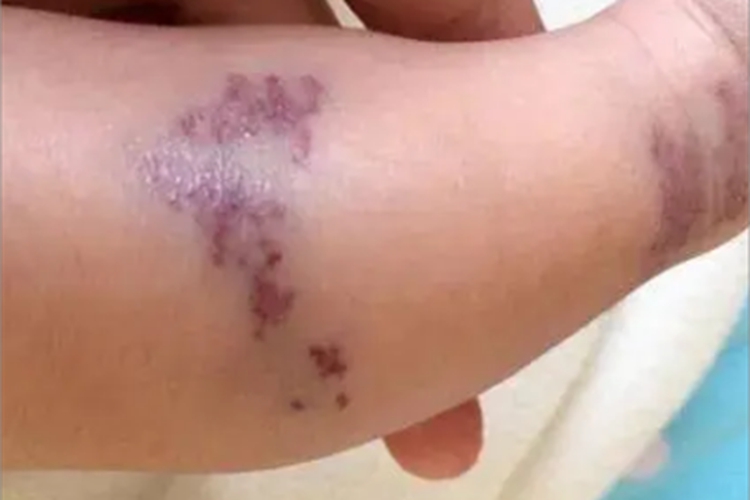 杆菌性血管瘤紫斑图 杆菌性血管瘤紫斑图