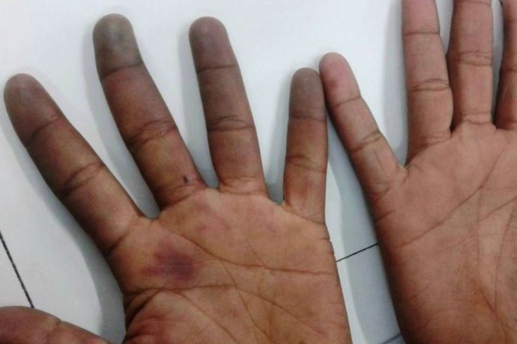 肢端青紫症症状图