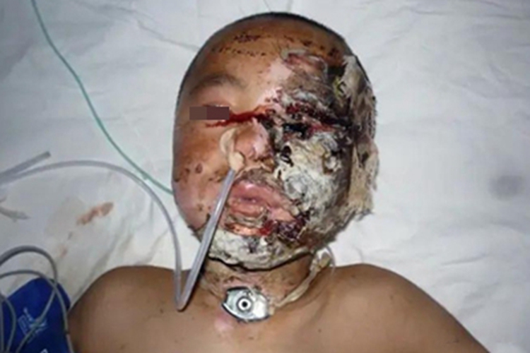 电烧伤面部症状图