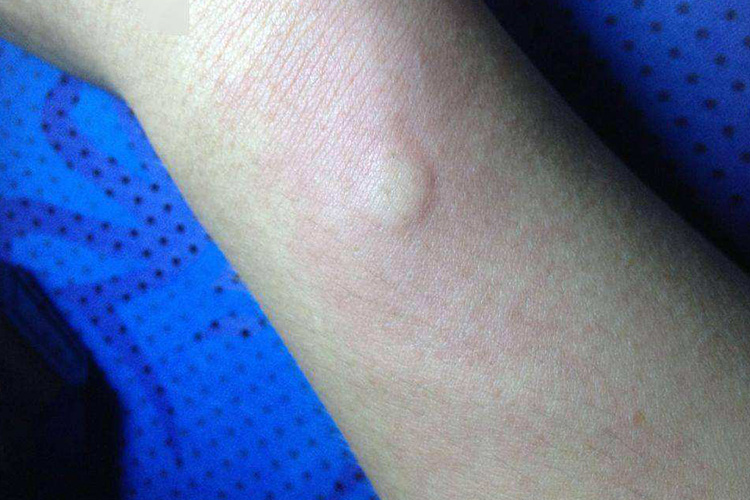 PPD试验中度阳性图