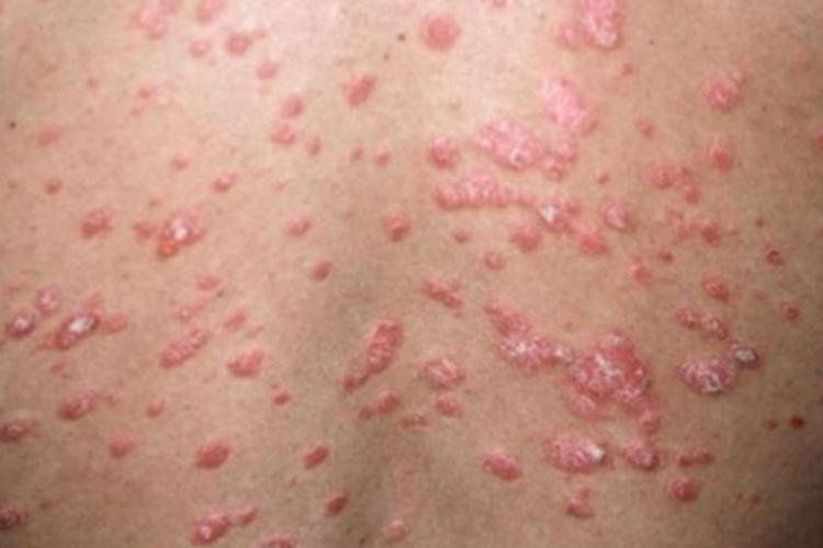 非特异性皮损图 非特异性皮损图