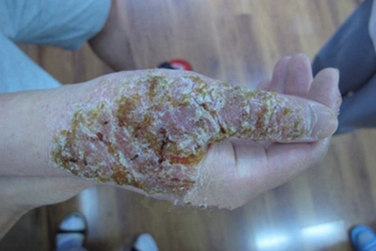 特应性皮炎手部症状图
