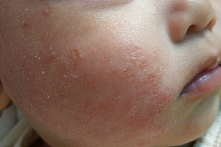 奶癣宝宝脸上粗糙起皮发红图 奶癣宝宝脸上粗糙起皮发红图