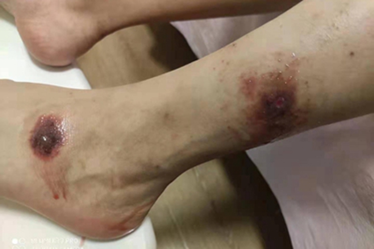 皮肤小血管炎小腿溃疡图