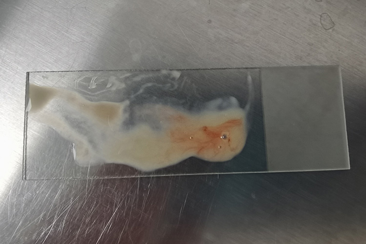 宫颈癌早期阴道分泌物图