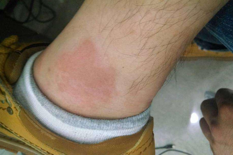 接触性皮炎脚踝一圈红斑图