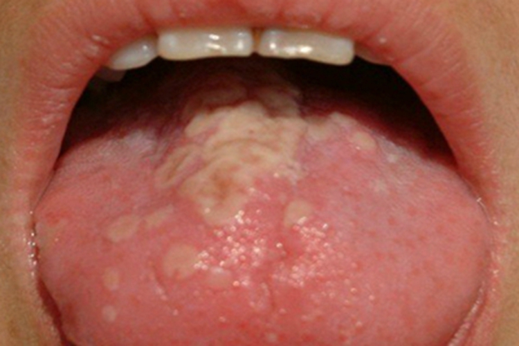 原发性口腔单纯性疱疹糜烂图 原发性口腔单纯性疱疹糜烂图