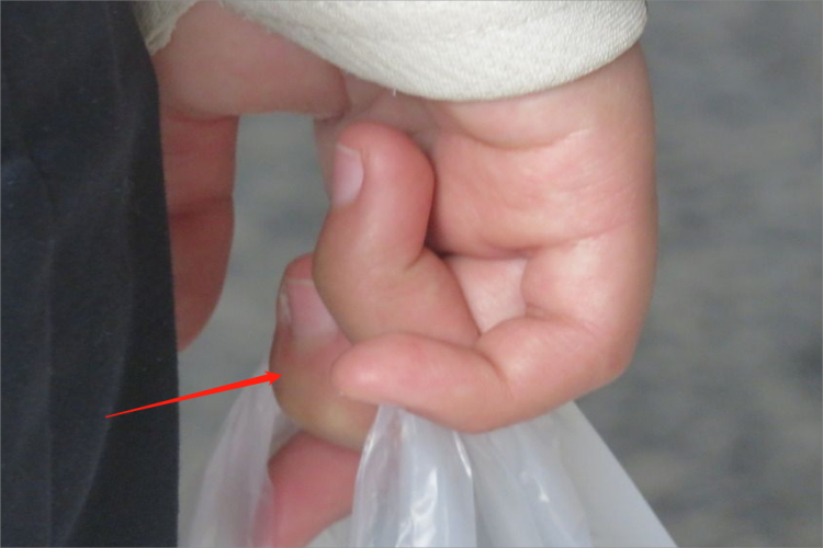 物理因素导致手指供血不足图