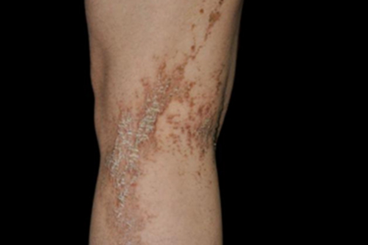 泛发型表皮痣腘窝丘疹图 泛发型表皮痣腘窝丘疹图