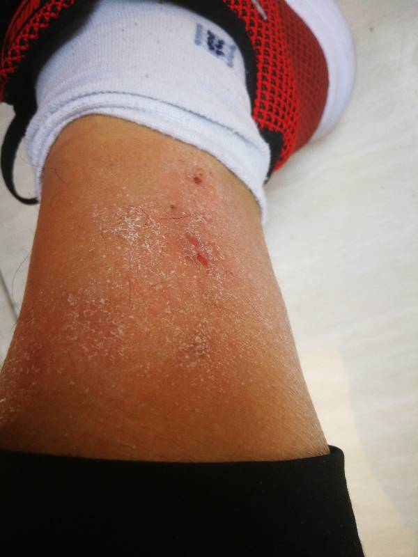 冬季瘙痒症的损害可发生在患者的小腿部位,局部皮肤粗糙干燥,并伴有