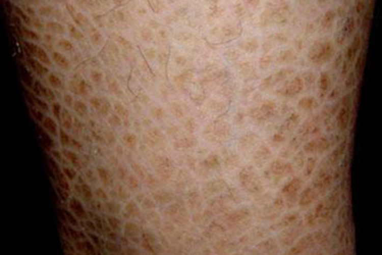 寻常型鱼鳞病小腿斑图