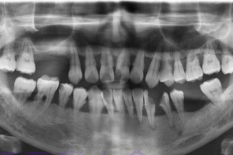 中度牙周炎X线影像图