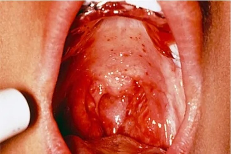 川崎病上颚红斑图