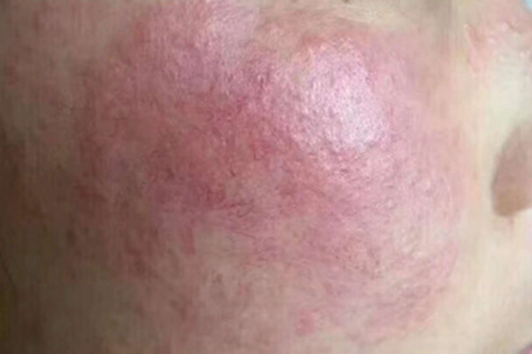糖皮质激素依赖性皮炎面部血丝图