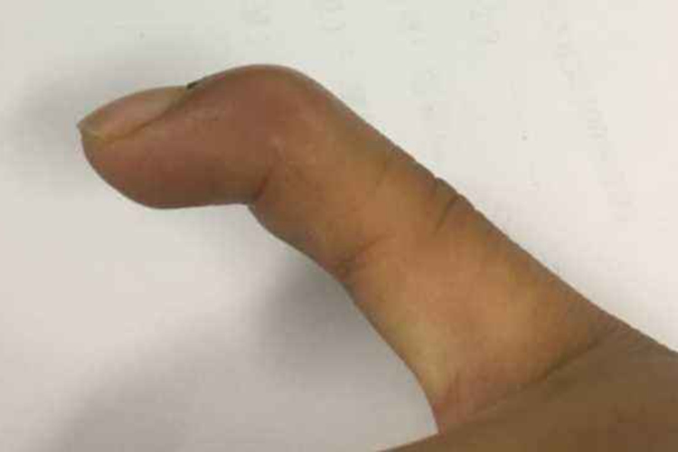 指伸肌腱损伤图 指伸肌腱损伤图