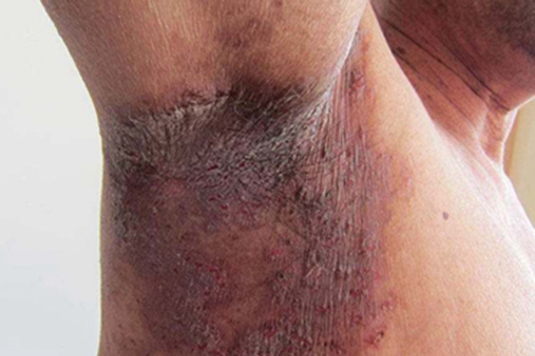 家族性良性天疱疮腋窝皮肤发黑图