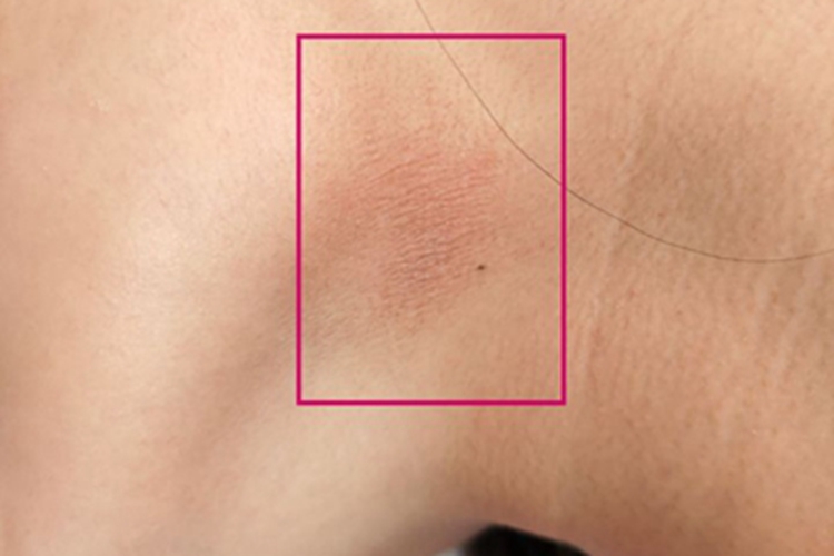 颈部假性皮萎缩侧颈症状图