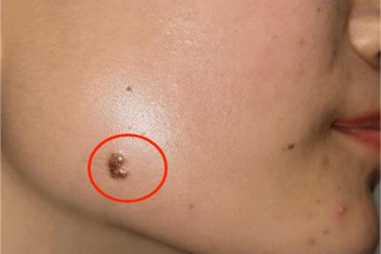 复合痣面部长斑图