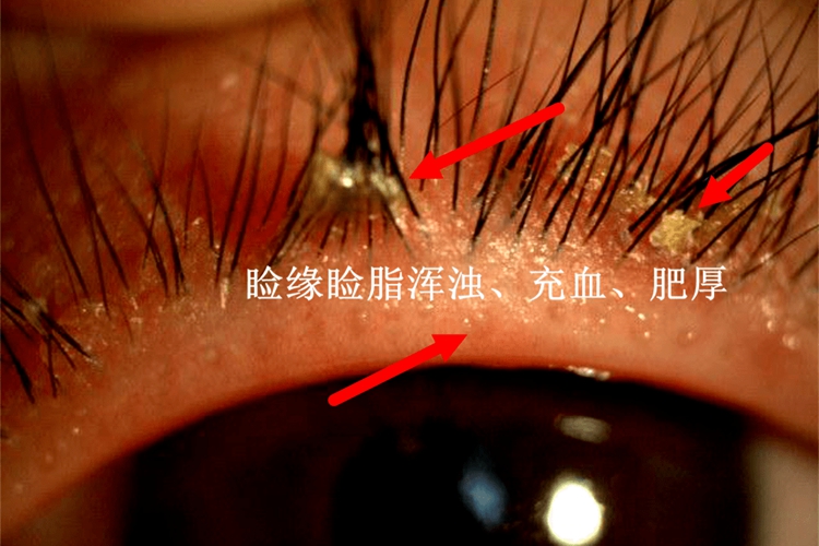 儿童鳞屑性睑缘炎图