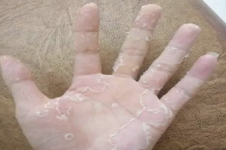 手指剥脱性角质松解症图