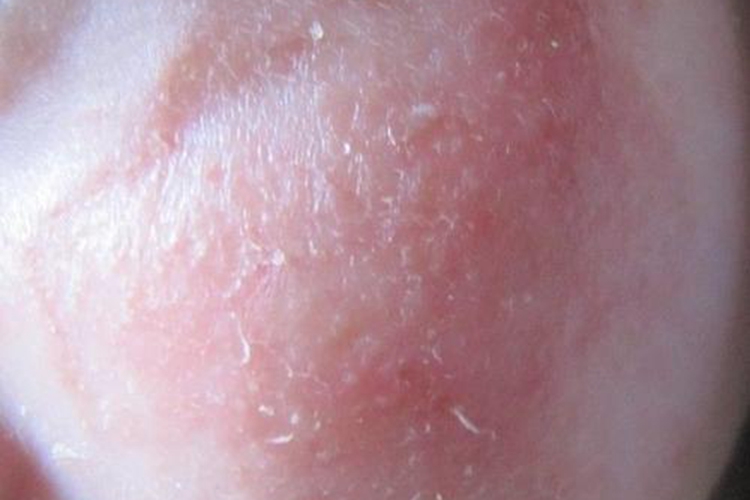 面部湿疮脾虚湿蕴图