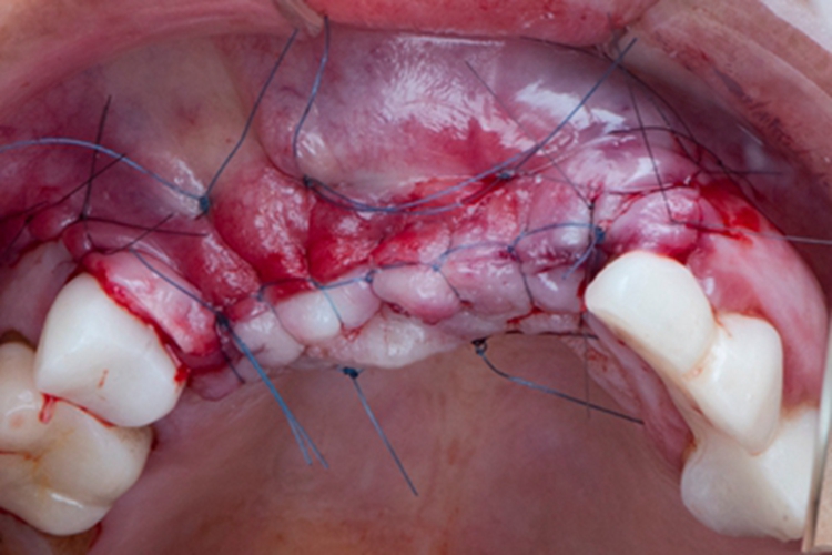 种植牙一期伤口渗血图 种植牙一期伤口渗血图