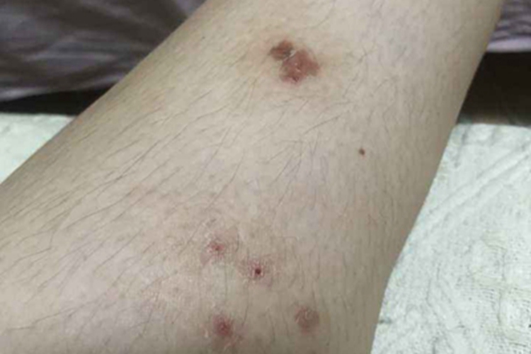 虱病小腿结痂图