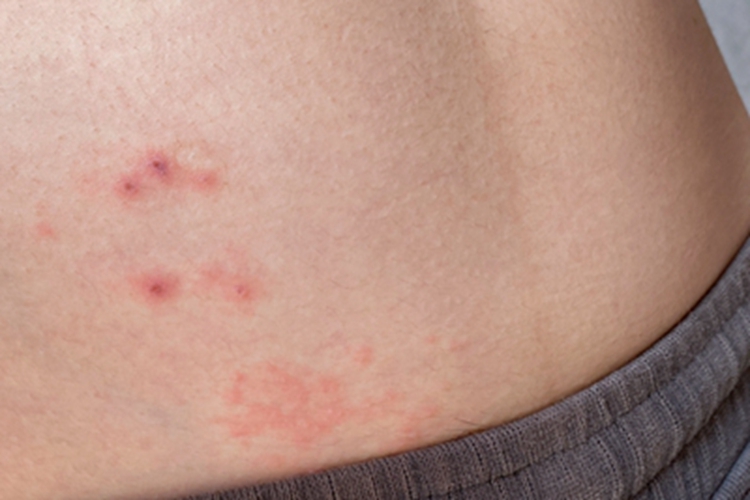 虫咬皮炎下腹结痂图