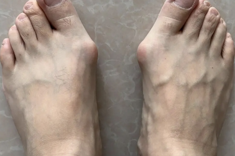 拇趾滑囊炎红肿图 拇趾滑囊炎红肿图