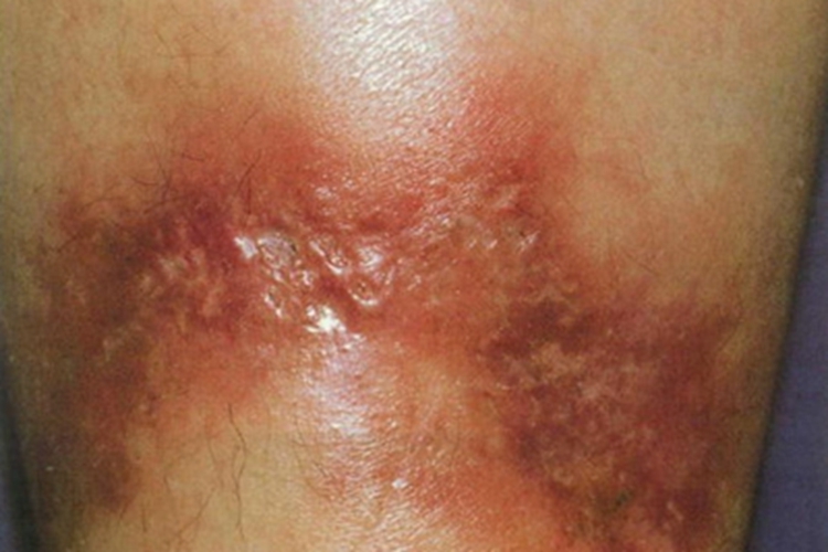 硬结性红斑小腿症状图