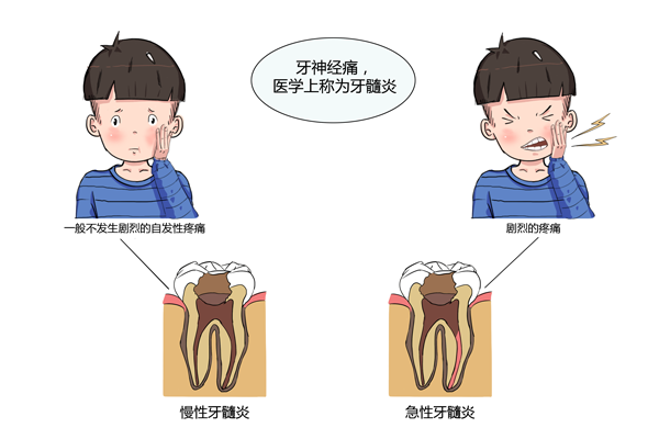 一,牙神经痛的判断方法1,急性牙髓炎的主要症状是剧烈疼痛,呈自发阵发