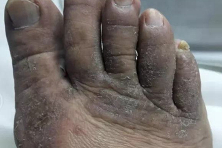 3级手足综合征脚趾皮肤发黑图 3级手足综合征脚趾皮肤发黑图