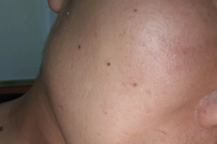 交界痣脸上有小黑点图 交界痣脸上有小黑点图