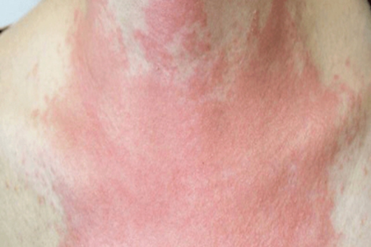 螨虫皮炎胸前大片红斑图 螨虫皮炎胸前大片红斑图