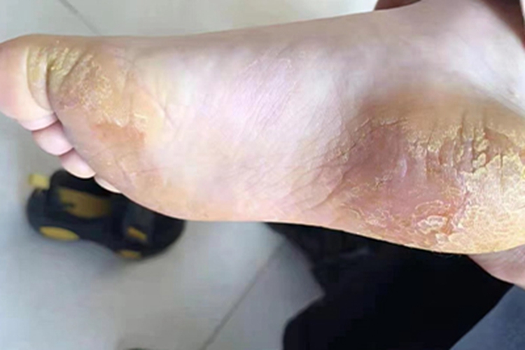 Ⅱ度皮肤皲裂症状图