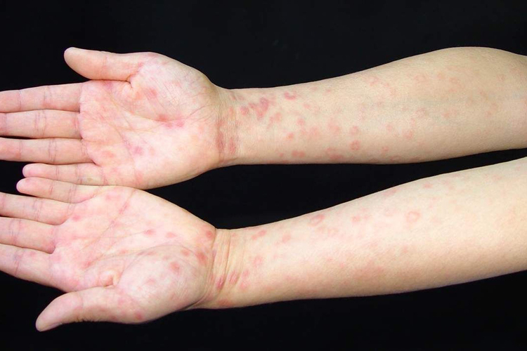 梅毒疹丘疹图 梅毒疹丘疹图