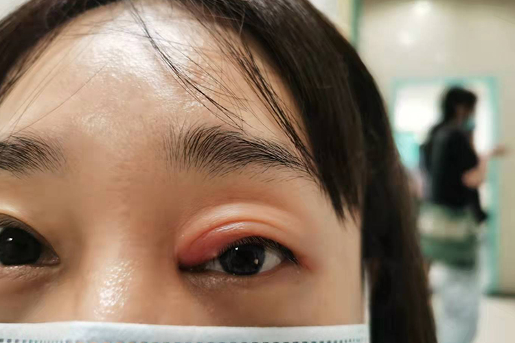 麦粒肿症状图