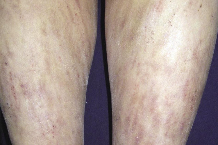 瘙痒症皮肤增厚图