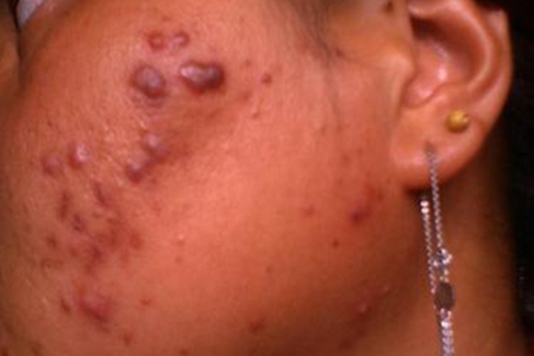 瘢痕疙瘩面部小红疙瘩图 瘢痕疙瘩面部小红疙瘩图