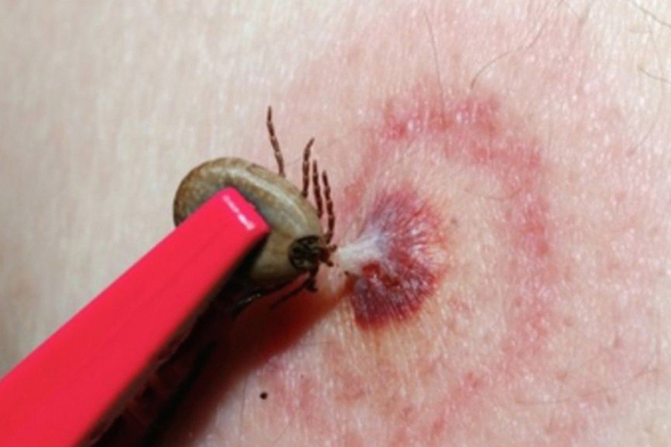 周围红斑水肿图