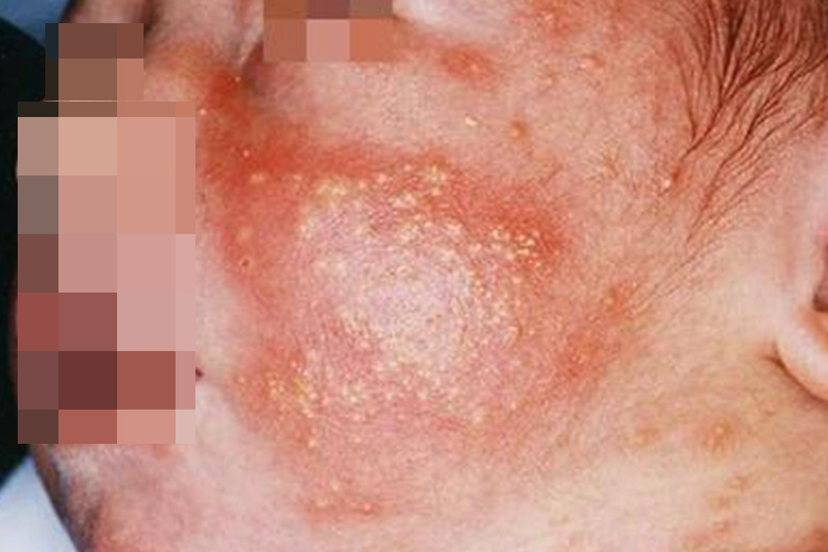 毒性红斑脸上红斑丘疹图